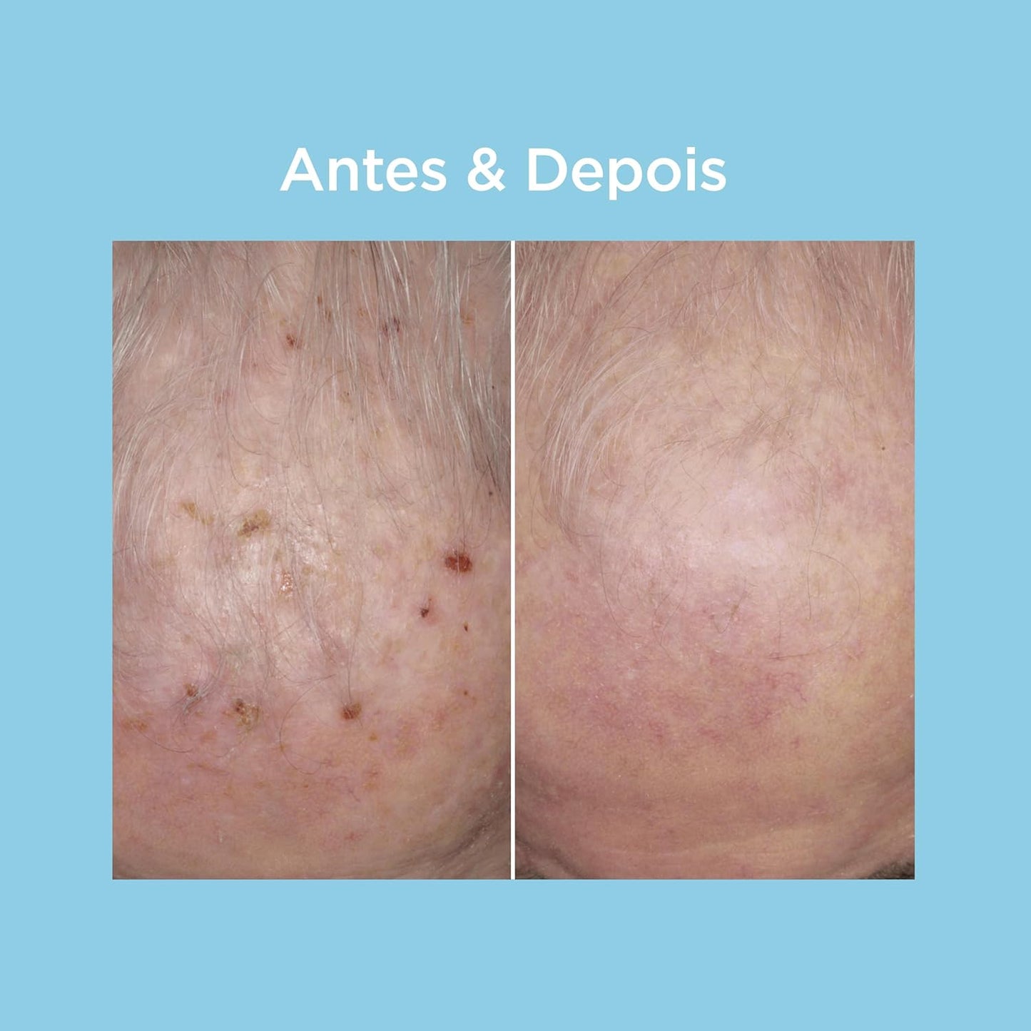 ISDIN Protetor Solar Facial Eryfotona AK-NMSC FPS 99-50ml